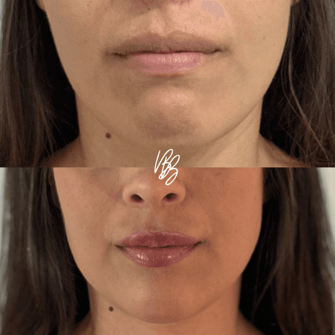 Botox Preenchimento queixo