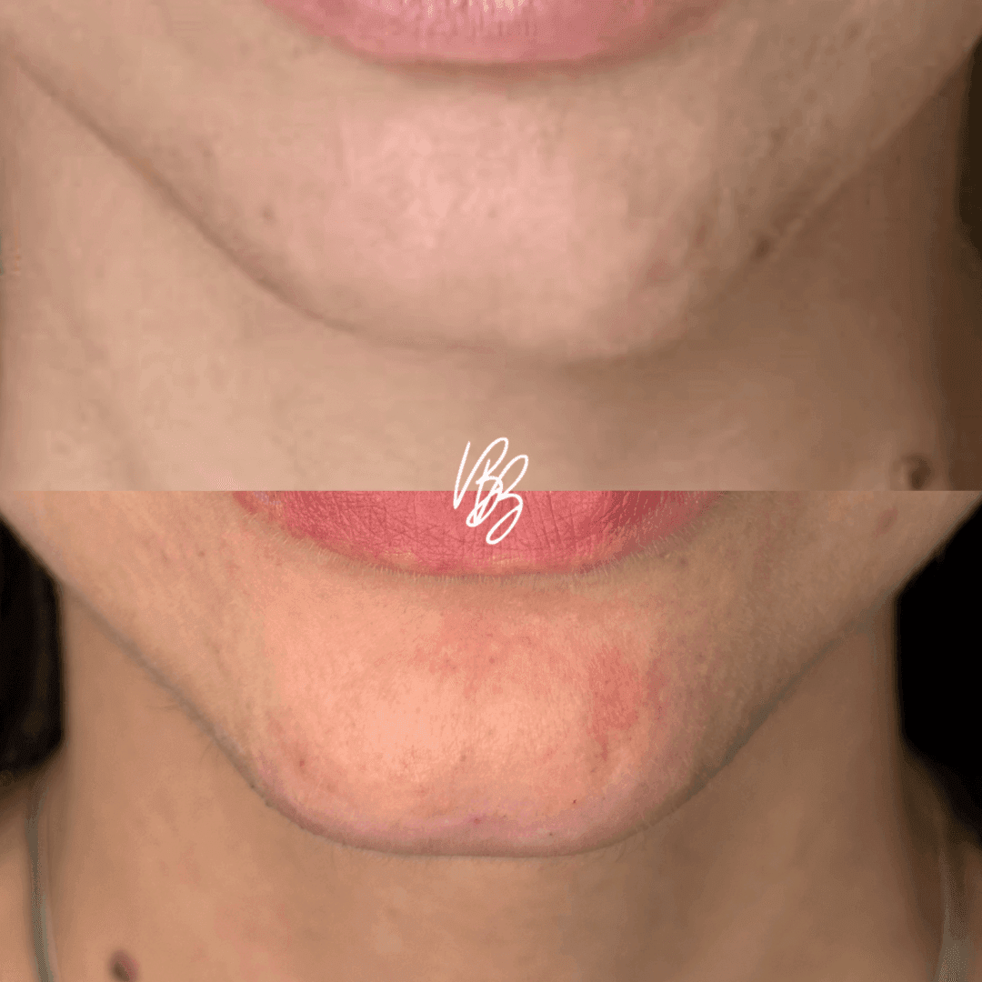 Botox correção de queixo