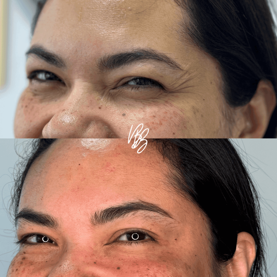 Botox orbicular dos olhos - Pé de galinha