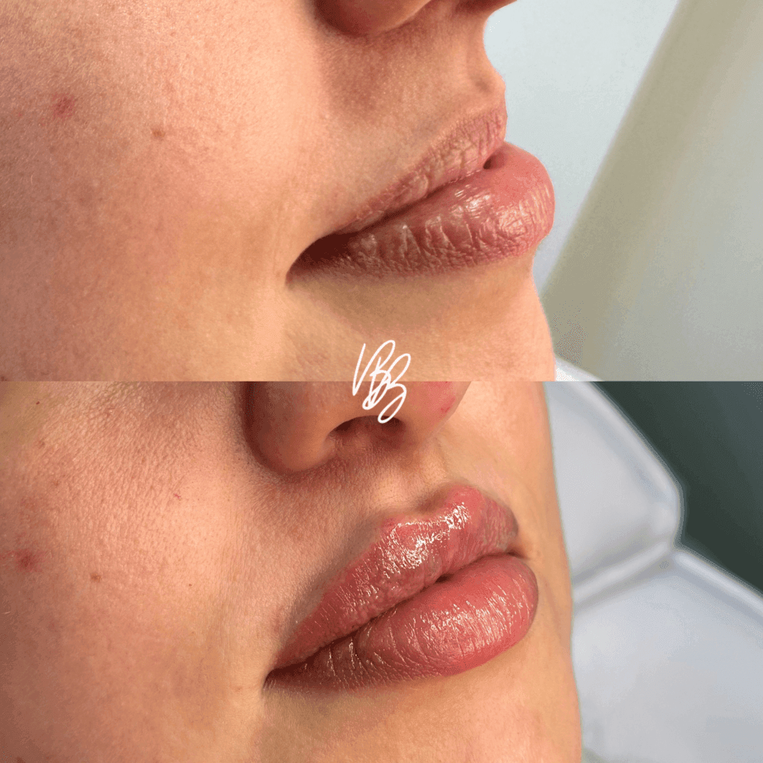 Preenchimento Labial 2