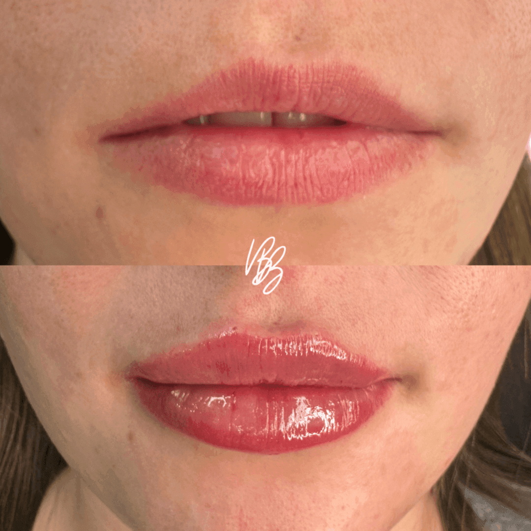 Preenchimento Labial 3